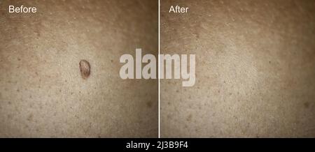 Photo avant et après l'enlèvement du grand Papilloma sur la peau de la femme. Concept de suppression de papillome. Mise au point sélective Banque D'Images