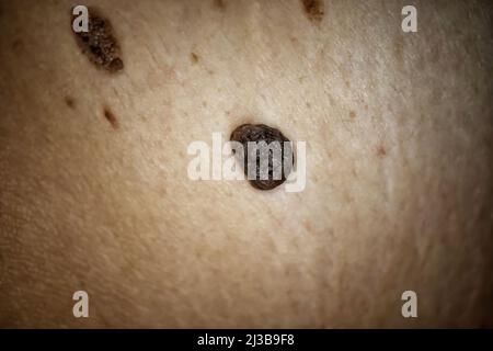 Grand taupe ou mélanome sur le dos d'une femme. Pigmentation sur le dos. Photo de santé médicale Banque D'Images