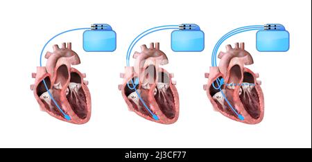 cœur et stimulateur cardiaque sur fond blanc 3d rendu, illustration anatomie cardiaque, section, ventricule droit et gauche, oreillettes, valves Banque D'Images