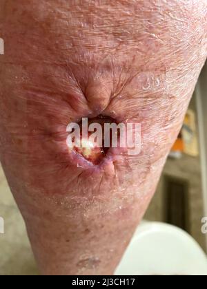 Blessure à jambe ouverte, 2 semaines après la chirurgie de Mohs, enlever le carcinome épidermoïde, sutures de cordon de sac à main, cavité, peau, sutures, Médical, IRM Banque D'Images