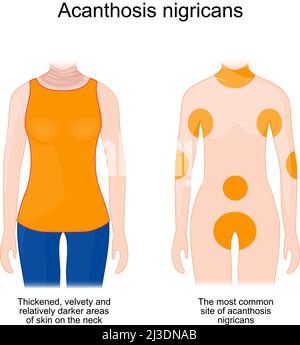 Acanthose nigricans. Zones de peau épaissies, veloutées et relativement plus foncées sur le cou. Le site le plus commun de l'acanthosis nigricans diabète de type 2 Illustration de Vecteur