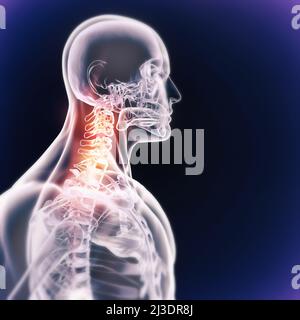 Quand l'inflammation frappe.Vue cgi d'un joint enflammé isolé en bleu. Banque D'Images