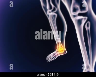 Quand l'inflammation frappe.Vue cgi d'un joint enflammé isolé en bleu. Banque D'Images