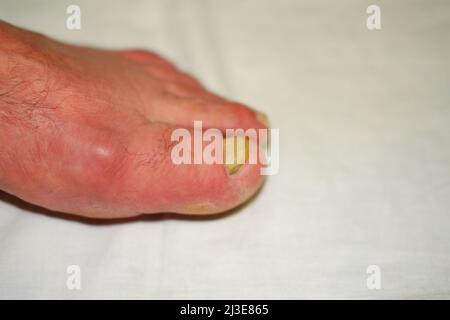 Toenails avec infection fongique des ongles Banque D'Images