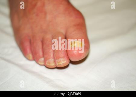 Toenails avec infection fongique des ongles Banque D'Images