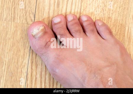 Infection fongique sur les ongles du pied de l'homme. Banque D'Images