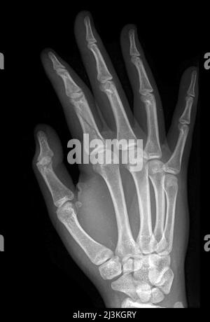 Deuxième fracture du phalange de la main, rayons X. Banque D'Images