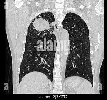 Carcinome pulmonaire, TDM Banque D'Images