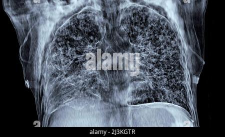 Tuberculose miliaire, 3D CT Banque D'Images