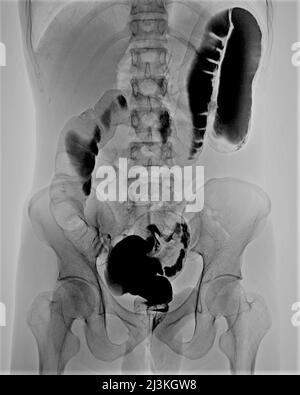 Mal rotation du côlon, rayons X. Banque D'Images