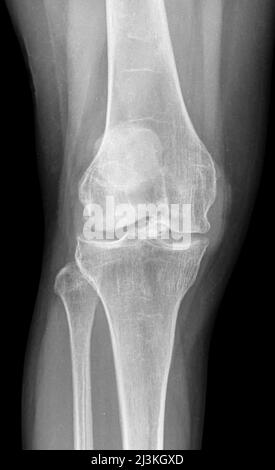 Syndrome de Hoffa Fat Pad, radiographie Banque D'Images