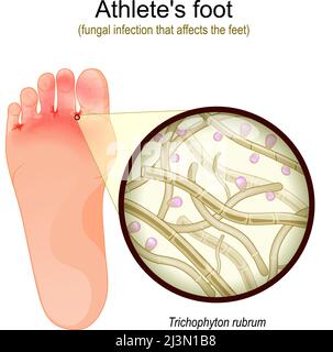 Le pied de l'athlète est une infection fongique qui affecte les pieds. La semelle du pied avec un champignon parasite. Gros plan des hyphes fertiles de Trichophyton rubrum, Macro Illustration de Vecteur