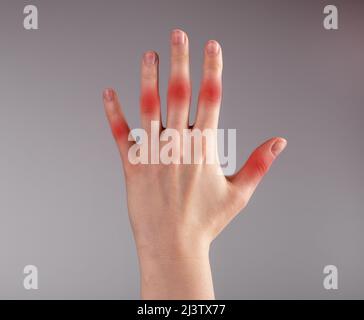 Douleur articulaire au doigt. Femme main avec tache rouge gros plan. Causes de blessures, entorse, tension. Syndrome du canal carpien, arthrite, maladies chroniques. Concept de soins de santé et de médecine. Photo de haute qualité Banque D'Images