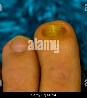 Gros plan de l'ongle d'orteil sain et infecté par un champignon, infection commune d'ongle et de maladie Banque D'Images