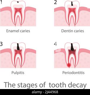 Les étapes de la carie dentaire, illustration vectorielle Illustration de Vecteur