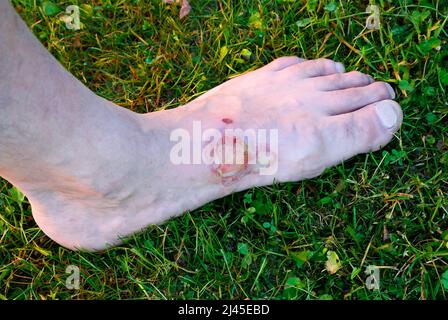 Brûlez de l'eau bouillante sur le pied Banque D'Images