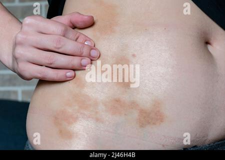 Taches rouges-brunes sur la peau d'une femme près de l'abdomen. Banque D'Images