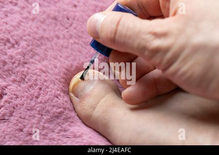 onychomycose, stade initial de la teigne tonsurante.Peindre le gros orteil avec un vernis médicamenteux, fond rose pacifique Banque D'Images