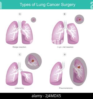 Types de chirurgie du cancer du poumon. Illustration le poumon 4 types de chirurgie causée par le cancer. Illustration de Vecteur