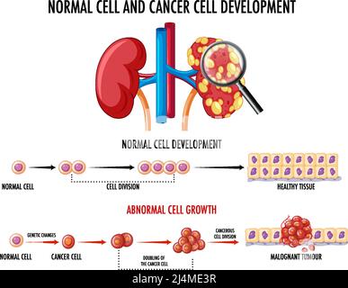 Schéma illustrant une cellule normale et une cellule cancéreuse Illustration de Vecteur