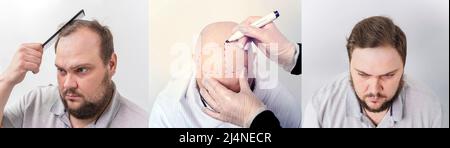 la calvitie masculine avant et après le traitement. portrait d'un homme avec un problème de calvitie à une opération de transplantation de cheveux. La chirurgie cosmétique. Le processus de hai Banque D'Images