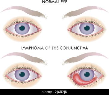 L'illustration médicale compare un œil sain à un œil affecté par un lymphome de la conjonctive. Illustration de Vecteur