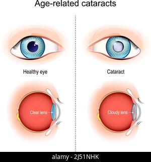 cataractes. Problèmes de vision liés à l'âge. Vue en coupe, montrant la position de la lentille humaine. Illustration vectorielle Illustration de Vecteur