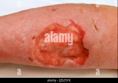 Complications des varices de la jambe inférieure. Grand ulcère trophique profond sur la jambe, défaut de la peau et des tissus mous. Plaie trophique pleurant, eczéma, dermati Banque D'Images