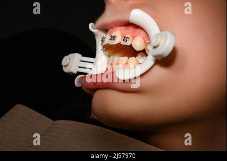Enrouleur blanc sur les lèvres et installation de bretelles métalliques sur les dents supérieures de l'adolescent, dents tortravers et les aligner avec les bretelles. Banque D'Images