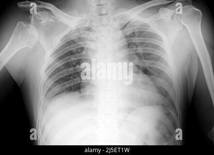 Délogée l'épaule droite, rayons X. Banque D'Images