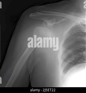 Délogée l'épaule droite, rayons X. Banque D'Images