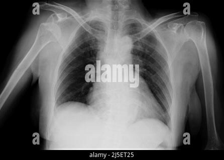 Délogée l'épaule droite, rayons X. Banque D'Images