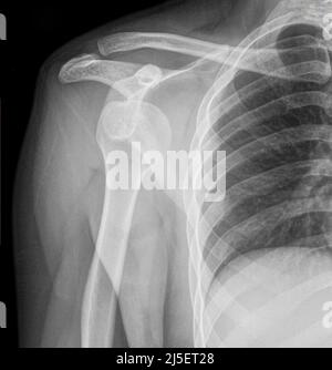 Délogée l'épaule droite, rayons X. Banque D'Images