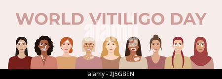 Journée mondiale du vitiligo juin 25 bannière horizontale. Visages féminins avec différentes ethnies, couleurs de peau, coiffures avec la maladie de peau de vitiligo. Corps positif c Illustration de Vecteur