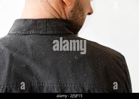 Gros plan sur les épaules de l'homme dans une chemise noire recouverte de passoire. Vue arrière. Copier l'espace. Le concept de psoriasis, dandruff et la dermatite séborrhéique Banque D'Images
