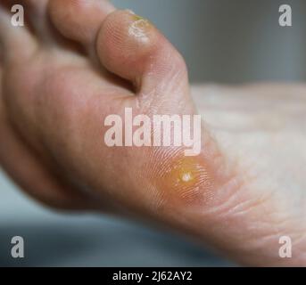 Verrue plantaire et callus sur le pied du patient. Retrait des verrues et des soins de la peau sur la plante des pieds Banque D'Images