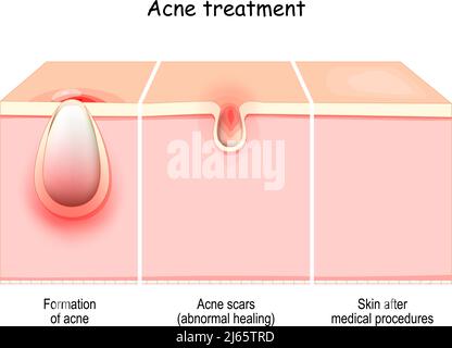 Traitement de l'acné. Coupe transversale d'une peau de la formation de l'acné aux cicatrices ou à la guérison anormale. Peau saine, peau avant et après la procédure médicale Illustration de Vecteur