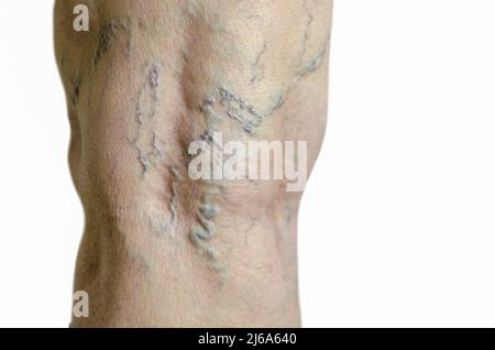 Jambe d'une femme plus âgée avec varices, thrombose veineuse profonde. Isolé sur fond blanc. Télangiectasias. Banque D'Images