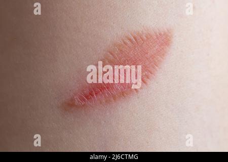 Blessure en forme de feuille sur la partie avant du bras d'une femme, texture macro de la peau Banque D'Images