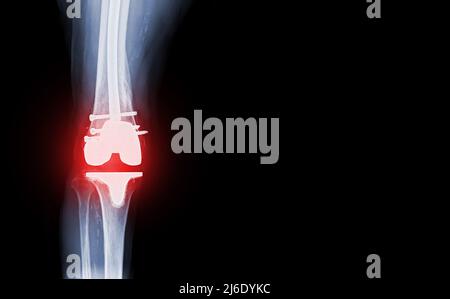 Filmer la vue AP du genou à rayons X du patient souffrant d'arthrose du genou et de l'articulation artificielle avec remplacement du genou. Banque D'Images