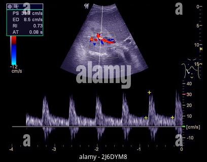 Échographie du haut de l'abdomen montrant le flux dans le canal biliaire commun après utilisation du Doppler couleur. Banque D'Images