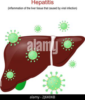 Hépatite. Inflammation du tissu hépatique causée par une infection virale. Foie de l'homme avec des virions de virus hépatite. Illustration vectorielle Illustration de Vecteur