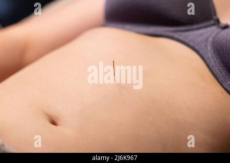 Un portrait d'une fine aiguille d'acupuncture entre le nombril et le sternum, mis en place par un acupuncteur. Ce traitement de médecine alternative est utilisé pour h Banque D'Images