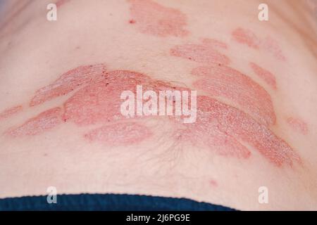 Grand rouge inflammation écailleuse éruption sur l'estomac.psoriasis aigu sur l'estomac chez un homme, rougeur sévère sur la peau, un dermatologique incurable auto-immune Banque D'Images