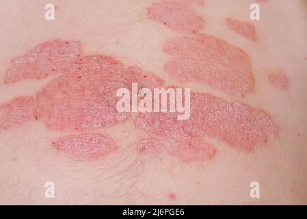 Grand rouge inflammation écailleuse éruption sur l'estomac.psoriasis aigu sur l'estomac chez un homme, rougeur sévère sur la peau, un dermatologique incurable auto-immune Banque D'Images