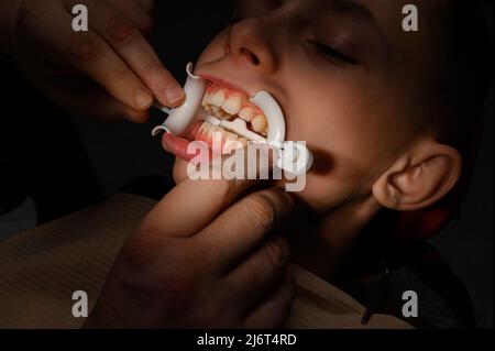 Rétracteur en plastique pour l'augmentation des lèvres dans la bouche, la procédure dentaire et rétracteur comme élément auxiliaire, lumière dirigée sur les lèvres. Banque D'Images