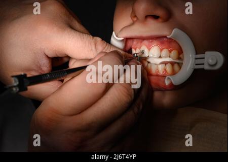 L'orthodontiste installe des bretelles pour le copain de l'étudiant, visite chez le dentiste, installation d'bretelles sur les dents supérieures, enrouleur sur le patie Banque D'Images