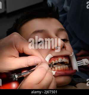 L'orthodontiste installe des bretelles pour le copain de l'étudiant, visite chez le dentiste, installation d'bretelles sur les dents supérieures, enrouleur sur le patie Banque D'Images