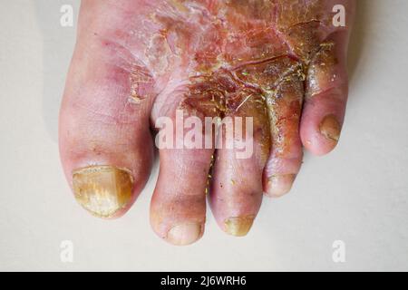 Pied de l'homme affecté par la maladie du pied de l'athlète (tinea pedis), France Banque D'Images