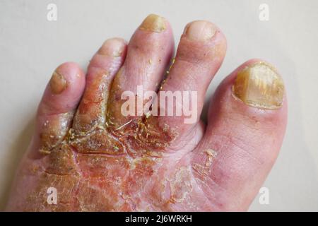 Pied de l'homme affecté par la maladie du pied de l'athlète (tinea pedis), France Banque D'Images